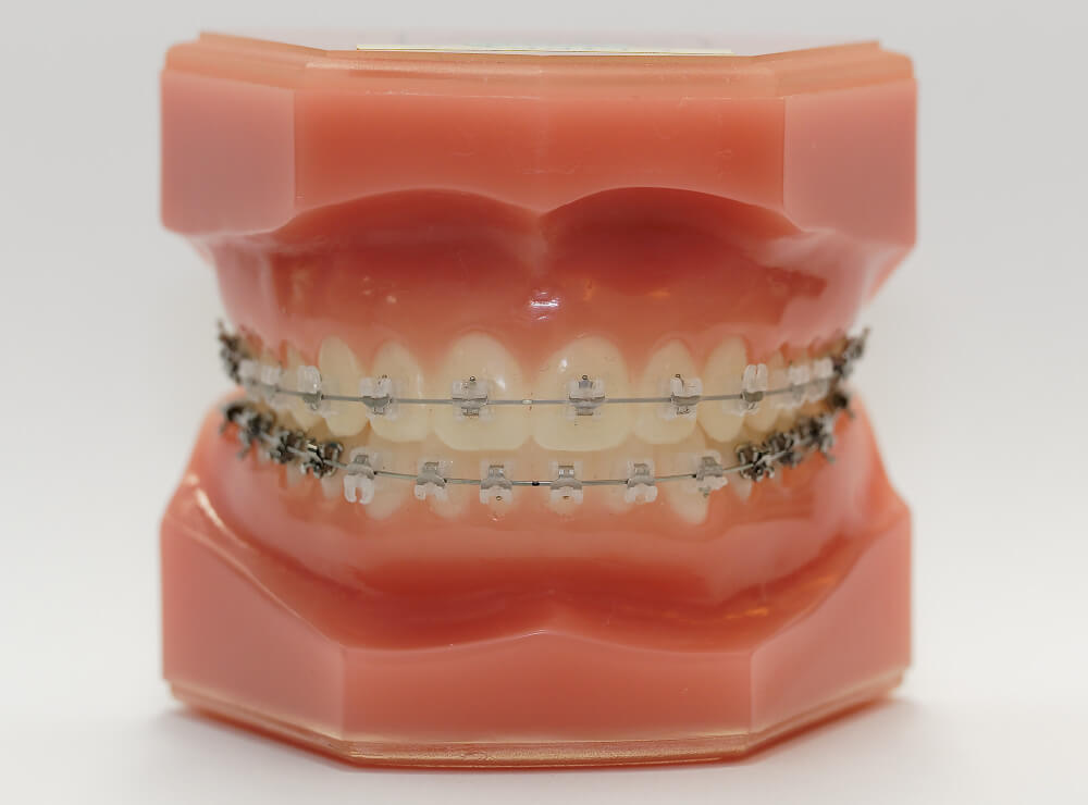 成人矯正｜立川の矯正歯科・小児矯正｜新井矯正歯科