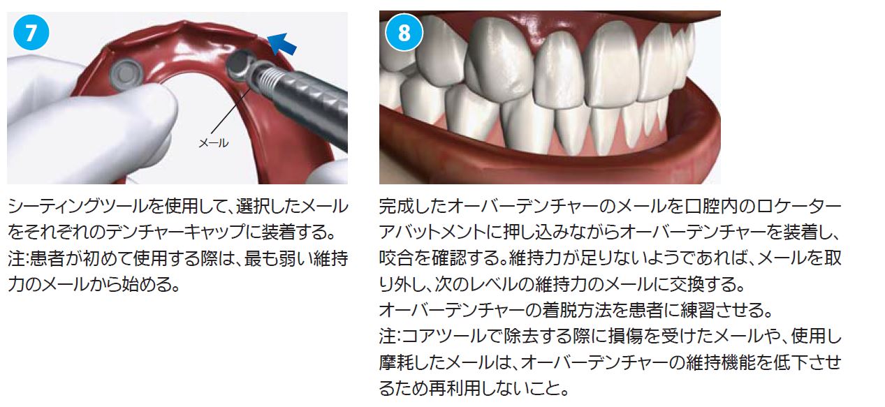 アバットメント(ロケーター）|株式会社インプラテックス