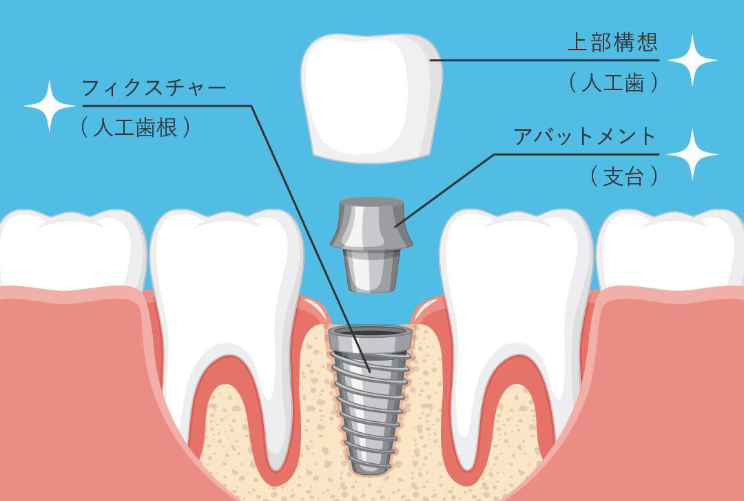 インプラント | 【公式】滋賀県西大津歯科医院｜滋賀県大津市のJR大津