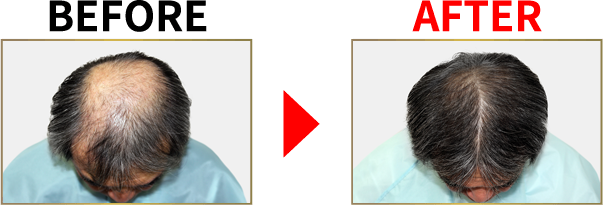 薄毛改善・発毛専門リーブ21 85.28%のお客様の抜け毛が減少 実感できる