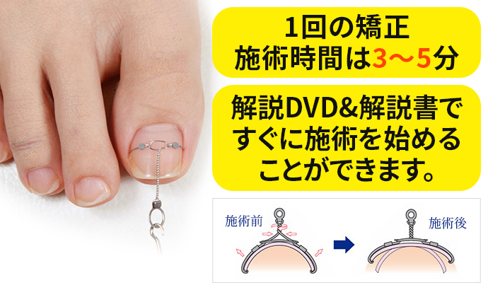 巻き爪矯正インベントプラス｜巻き爪矯正・フットケア器具製造・販売