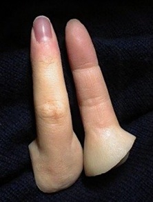 神奈川県藤沢市の義指(エピテーゼ)製作 ARTWORKS(アートワークス)