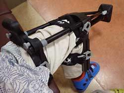 カナダ脚；iWalkfree 2.0（ニークラッチ：アイウォークフリー）