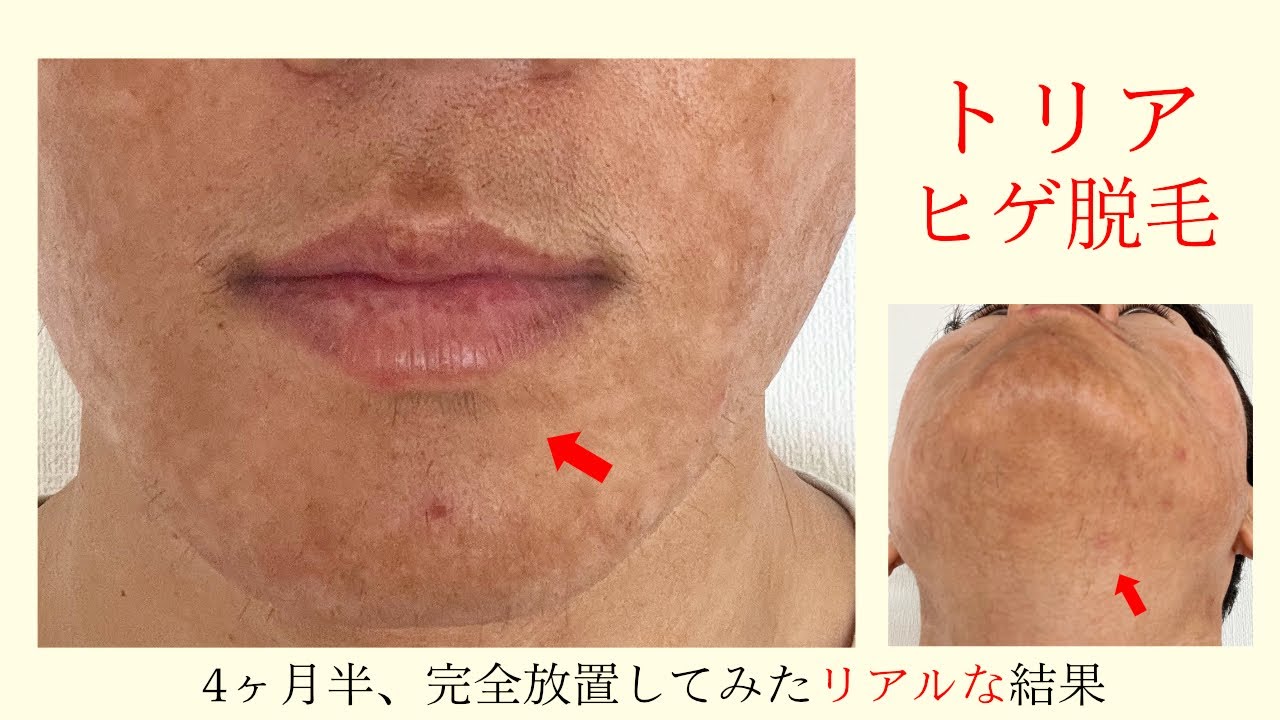 トリア】髭脱毛を4ヶ月半全くしてみなかった結果・・・ヒゲは脱毛後に